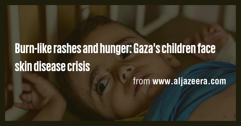 Burn-like rashes and hunger: Gaza's children face skin disease crisis ...